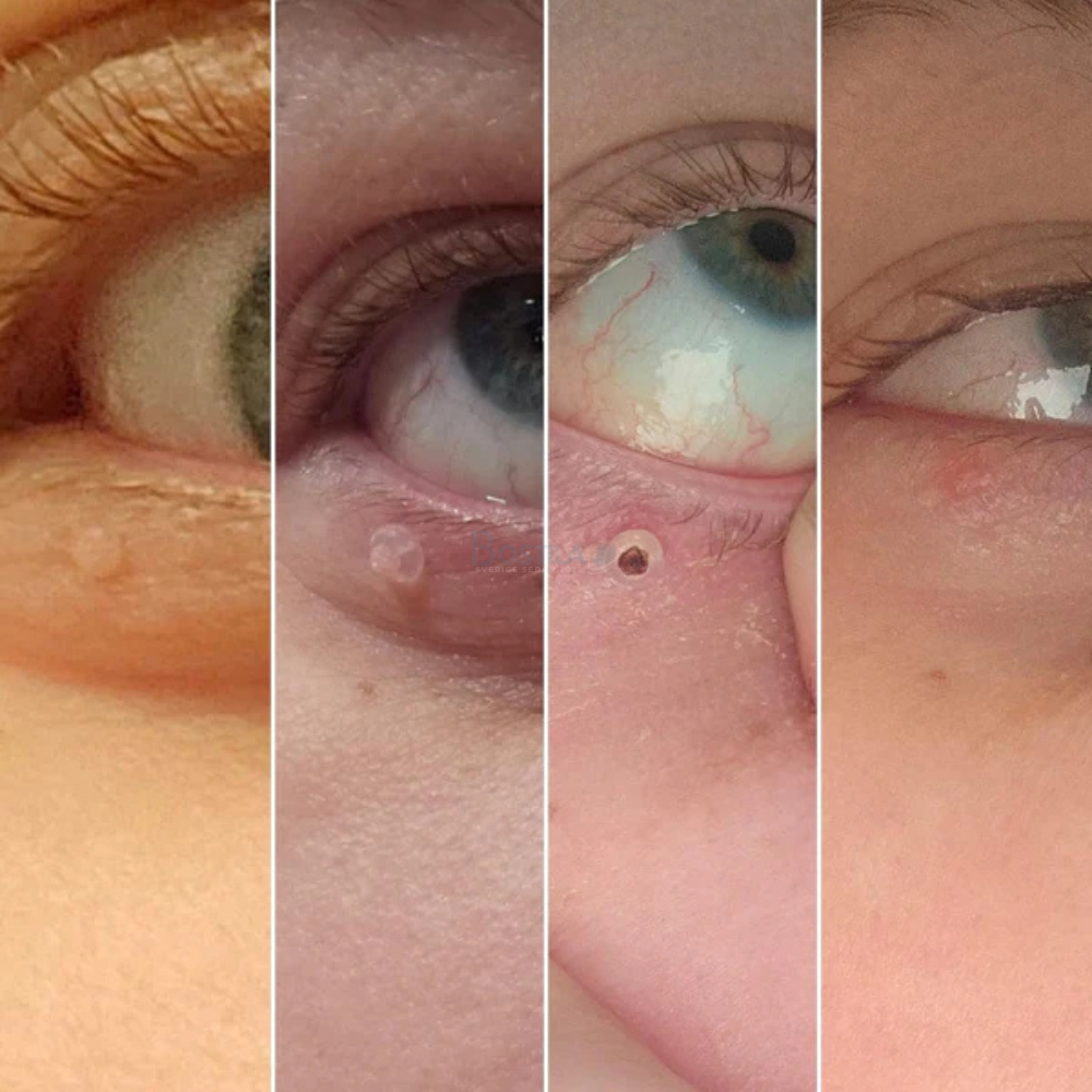 TagBuddy™ - Premiumset mot hudflikar – Synliga resultat utan smärta